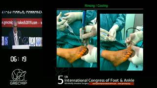 Basic Percutaneous Course  DMMO Distal Metatarsal MiniInvasive Osteotomy [upl. by Georgi]