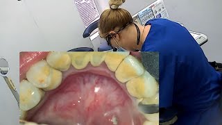 Dental visit  Teeth cleaning  Scaling [upl. by Cormick]