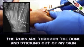 Removing 4 rods pins from Boxers Break  No anesthetic [upl. by Crane]