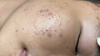 ACNE TREATMENT VU QUYNH MI  Blackheads On Boy Face 2024FULL [upl. by Phionna]