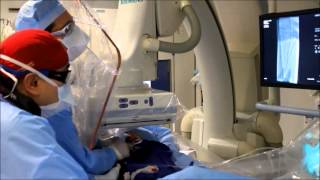 Atherectomy for PAD at Mount Sinai NYC [upl. by Ahsatak176]