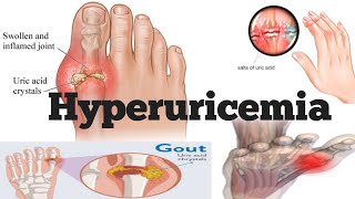 Hyperuricemia  Hyperuricemia Cause  Hyperuricemia Symptoms  Hyperuricemia Diagnosis amp treatment [upl. by Lednik]