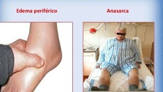 CASE Presentation of ANASARCA  Medicine [upl. by Connell672]