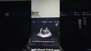 Mitral Valve Prolapse by echocardiogram 😱😢 echocardiogram echocardiography heart [upl. by Prudi]