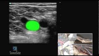 How To Deep Vein Thrombosis Ultrasound Exam 3D Video [upl. by Sinclair]