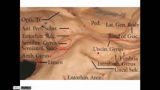 Neurosurgery Temporal lobe anatomy and its implications in temporal lobe epilepsy [upl. by Polito]