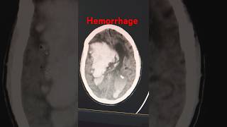 Ct scan hemorrhage ctbrain ctscan hemorrhage bloodpressure hypertension blood head cthead [upl. by Nitsua512]