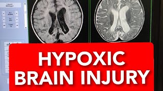 MRI of Hypoxic Ischaemic Brain Injury 10months Child shorts shortsvideo shortsvideos [upl. by Jobi]