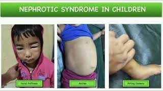 Nephrotic syndrome History mrcpch Clinical [upl. by Reginauld631]