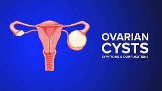 Ovarian Cysts  Symptoms and Complications Explained by an OBGYN [upl. by Hooper]