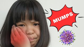 Mumps  Causes Signs amp Symptoms Diagnosis And Treatment [upl. by Rasia]