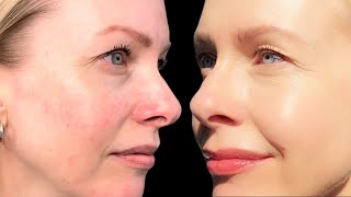 AZELAIC ACID  how to layer in your routine  it FIXED my ROSACEA [upl. by Virg443]