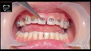 DIASTEMA CLOSURE  BRACES  Orthodontics dentalbraces dentalclinic dental trending anantnag 🙂🙂🙂 [upl. by Zebe]