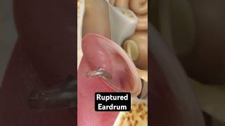 How does an eardrum rupture 3D Animation [upl. by Mccready]