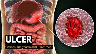 Ulcer Causes Signs and Symptoms Diagnosis and Treatment [upl. by Camila206]