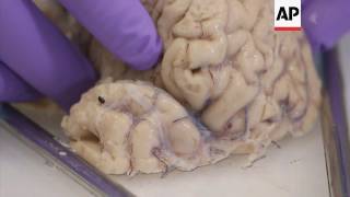 Parkinsons disease  a journey through a brain [upl. by Yeniffit]