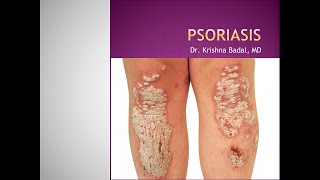 Psoriasis [upl. by Alfonso]