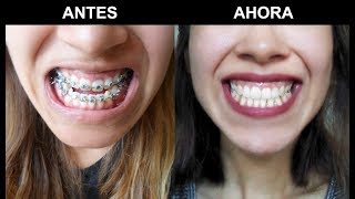 Antes y después cirugía ortognaticamaxilofacial [upl. by Perl]