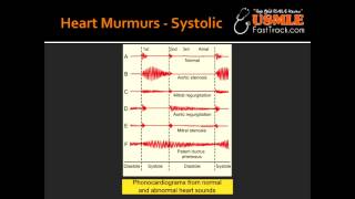 Heart Murmurs  Aortic Stenosis [upl. by Oran278]