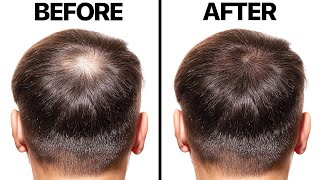 Minoxidil for Hair Loss [upl. by Oicnedurp463]