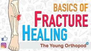 Fracture Healing  ANIMATION  BASICS  The Young Orthopod [upl. by Llenyr]