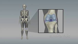 Osteoarthritis of the knee Choosing the right pain medicine [upl. by Airan630]