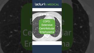 🔍 CT Scans Unveiled Centrilobular Emphysema Emphysema Radiology usmle copd [upl. by Aldo]