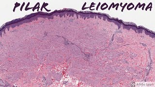 Leiomyoma Pilar Type Piloleiomyoma 5Minute Pathology Pearls [upl. by Brothers980]