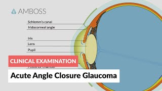 Acute Angle Closure Glaucoma [upl. by Otrepur503]