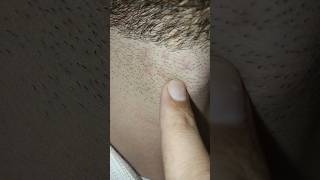 Problem after shaving beard neckline hair removal beard skincareyoutubeshortsviralshort [upl. by Paloma]