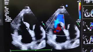 VENTRICULAR SEPTAL REPTUREVSR [upl. by Idnar43]