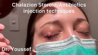 Chalazion Easiest and simplest Treatment with Steroid and Antibiotic Injections [upl. by Naginnarb950]