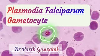 Plasmodia Falciparum Gametocyte  Morphology in Peripheral blood smear [upl. by Teews]