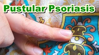 Pompholyx of Pustular Psoriasis  Topical Corticosteroids amp Antibiotics  Betamethasone  Gentamicin [upl. by Py]