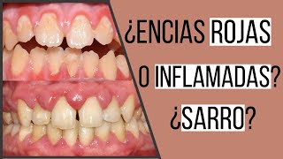 Gingivitis  encías inflamadas  Odontologia Con Cri [upl. by Antoine]