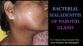 Bacterial Sialadenitis of parotid gland  An interesting case report [upl. by Linnie]