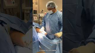 Lipedema Liposuction of Arm and Forearm  Dr Boris Volshteyn [upl. by Brightman]