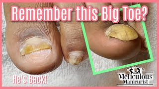 Return of the Detached Toenail with Amazing Pedicure Transformation for Men [upl. by Palm424]