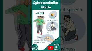 Spinocerebellar ataxia SCA  pathology diagnosis and treatment  1 minute pathology [upl. by Magan28]