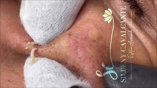 ACNE TREATMENT  Super Satisfying blackheads  004 [upl. by Etyam]