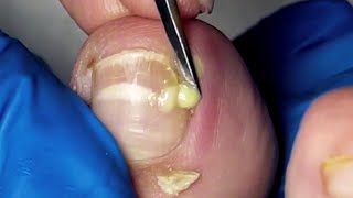 Pus Leaks Out From Infected Ingrown Toenails 【Yinuo Pedicure】 [upl. by Jesher]