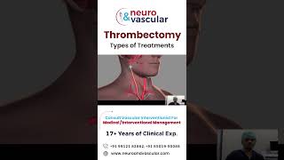 Thrombectomy types and treatments [upl. by Darnoc]