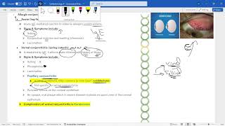 Ophthalmology 9 – Conjunctival Diseases [upl. by Cynthea]