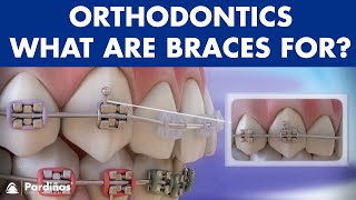 How Braces Work Elements of the orthodontic treatment and its role © [upl. by Chuch417]