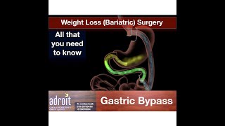 Obesity Weight lossBariatric Surgery Laparoscopic Gastric Bypass surgery Ahmedabad India [upl. by Ylim497]