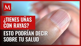 Las rayas en las uñas podrían ser un indicativo de algunas condiciones médicas te contamos cuáles [upl. by Em]