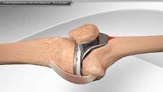 Knee Replacement with the iBalance TKA System [upl. by Keelby]