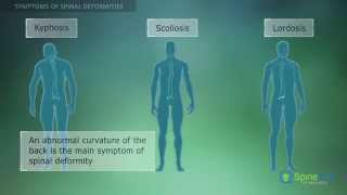 Spinal Deformities Symptoms [upl. by Ahiel911]