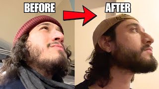 Minoxidil For Beard Growth Honest Thoughts amp Review [upl. by Chico]