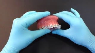 How to use orthodontic wax [upl. by Farrison]